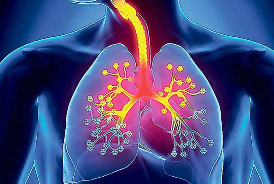 Cephalexin for Pneumonia: A Pulmonologist's Perspective