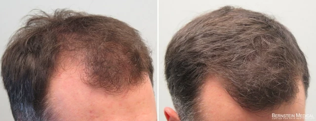 Nifedipine and Hair Loss: Is There a Connection?