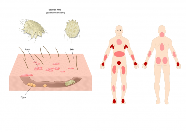 The life cycle of Sarcoptes scabiei and its impact on human health