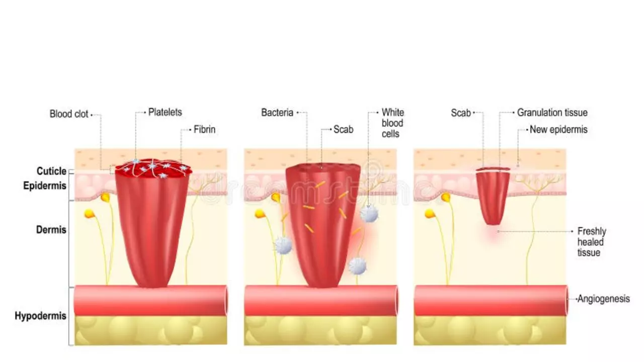 Blood clots in stents: understanding the role of inflammation