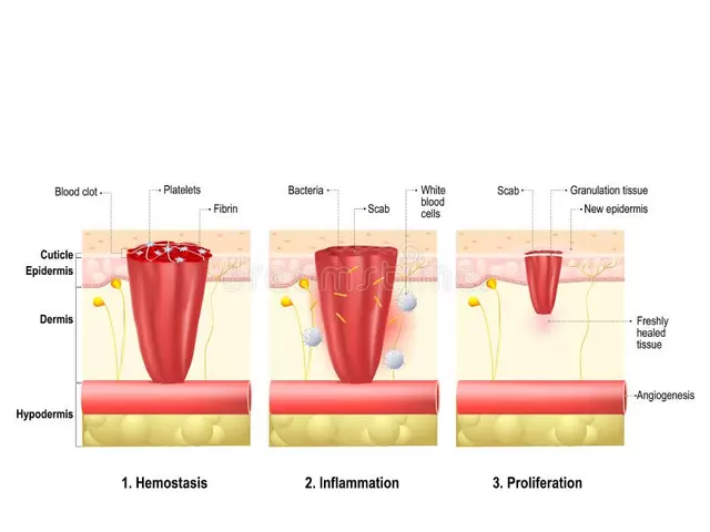 Blood clots in stents: understanding the role of inflammation